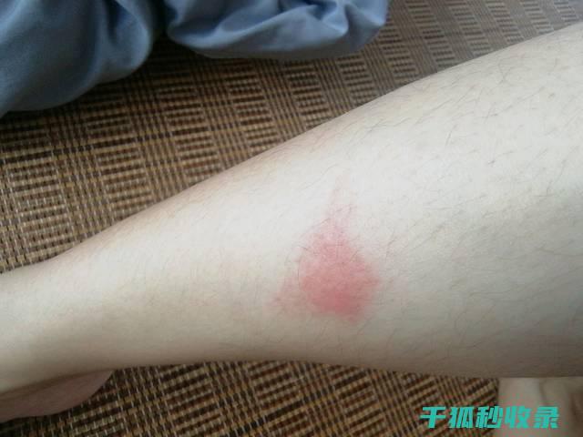 蚊虫叮咬后的止痒妙招
